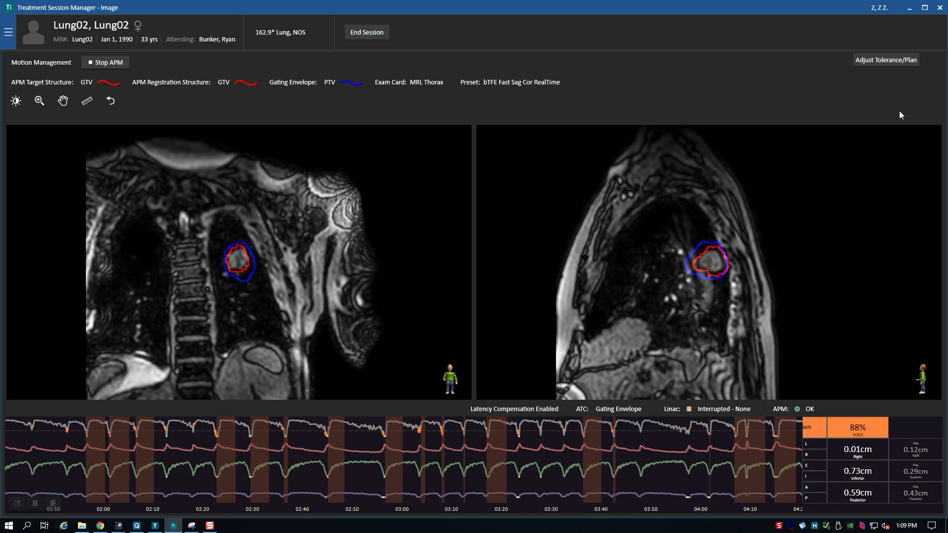 Screen capture of Elekta Unity Motion Management interface, a graph at the bottom tracking patient movement.